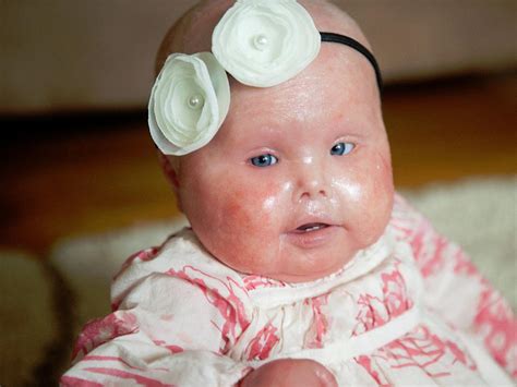 Meet Brenna A Baby With Harlequin Ichthyosis Photo 24 Pictures