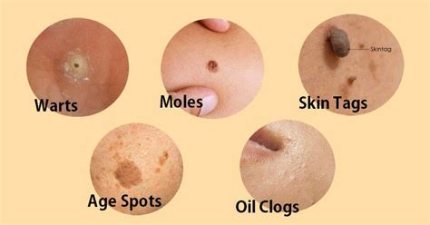 How To Remove Warts Moles Skin Tags And Age Spots Naturally