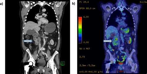 A Coronal Sections Ct Scan With Iv Contrast Illustrating Mass
