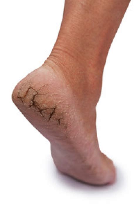 It's very convenient to have something there for many different reasons, including the following: What Treatment Options Are Available for Cracked Heels?