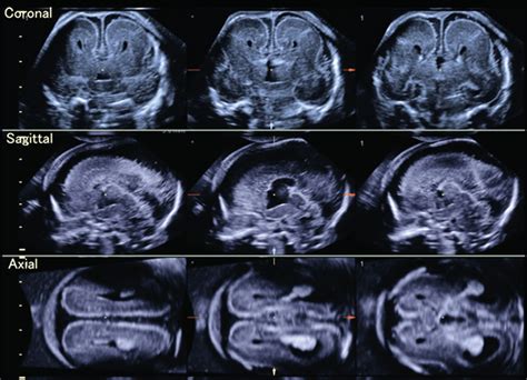 Tomographic Ultrasound Images In A Case Of Agenesis Of The Corpus