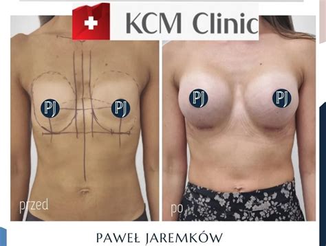 Kcm Clinic Weight Loss Surgery In Jelenia Gora Poland Clinichunter Com