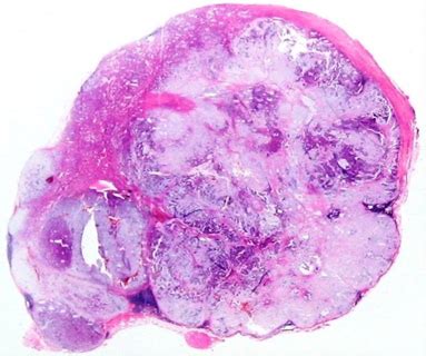 El adenoma pleomorfo es el más frecuente de los tumores benignos originados en todas las glándulas salivales, tanto mayores como menores. Adenoma pleomorfo sobre heterotopía salival: reporte de ...