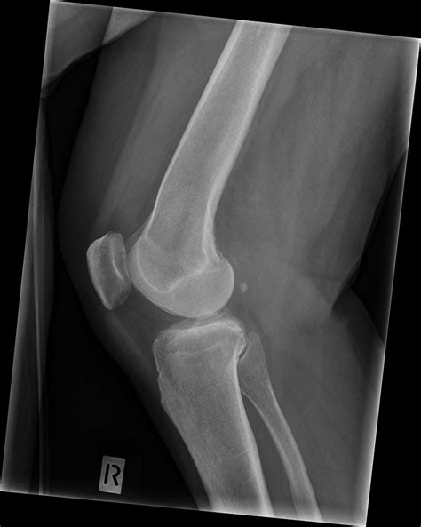 Lateral Knee Radiography Wikiradiography