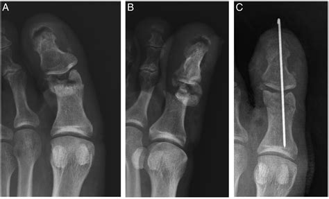 Osseous Injuries Of The Foot An Imaging Review Part 1 The Forefoot