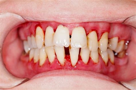Bad Gums Salvaggio Dentistry Blog