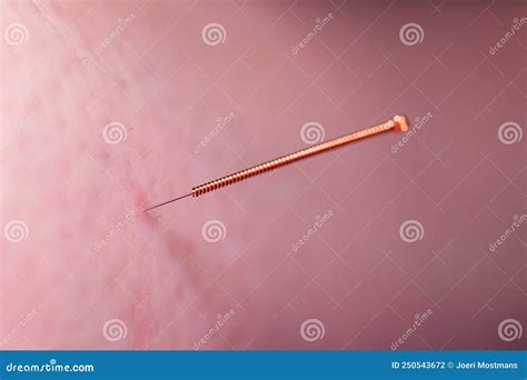 An Acupuncture Needle Sticking Into The Skin Of A Patient The Small