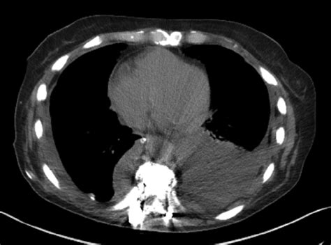 Chest Computed Tomography Scan Demonstrating Leftsided Pleural