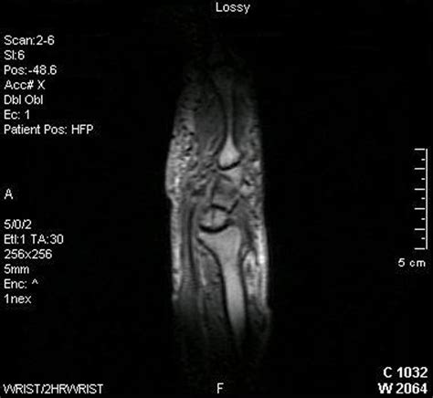 Multiple Cysts In Carpal Bones Eurorad