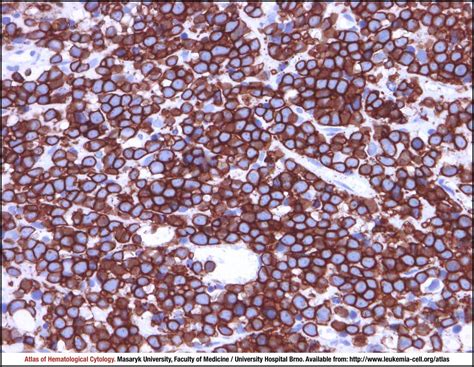 Burkitt Lymphoma Cell Atlas Of Haematological Cytology