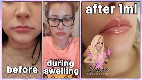 NATURAL Lip Filler Experience 1ml Before And After Lip Injections