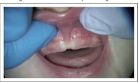 Diagnosing And Understanding The Maxillary Lip Tie Superior Labial The Maxillary Labial Frenum