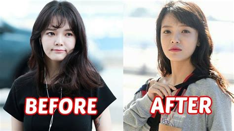 Lilypichu Plastic Surgery Before And After