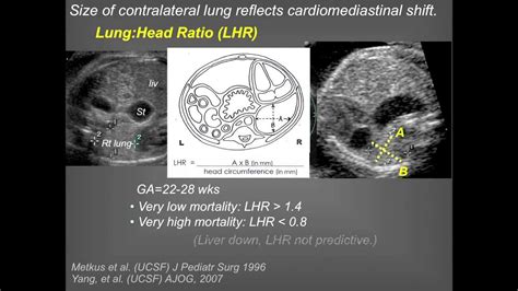 Ucsf Radiology A New Challenge Congenital Diaphragmatic Hernia Cdh