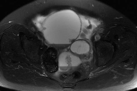 § cystic lesion with the ovary either at the margin or suspended within the lesion. Adnexal lesion (ovarian) | Body MRI