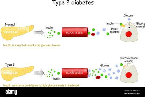 Types 2 Of Diabetes Mellitus Comparison Of Cell Work In Diabetes And