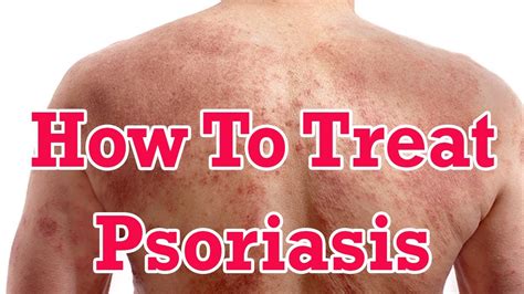 How To Treat Psoriasis Naturally Best Home Remedies To Cure Psoriasis Youtube