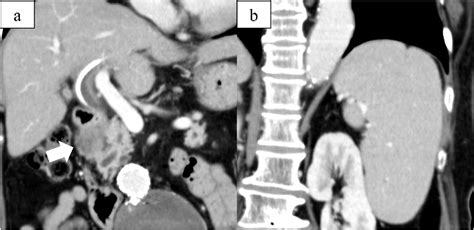 Figure 1 From Pancreaticoduodenectomy Combined With Splenectomy For A