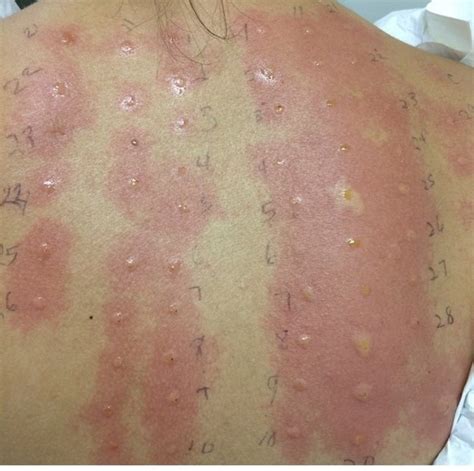 27 Allergic Reactions That Are So Bad Theyll Actually Make Your Face Hurt