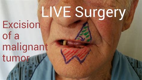 Abbe Flap Live Surgery Lip Reconstruction After Tumor Excision Youtube