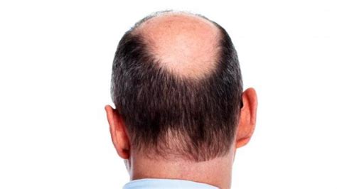 Penyebab Rambut Rontok Dan Kepala Botak