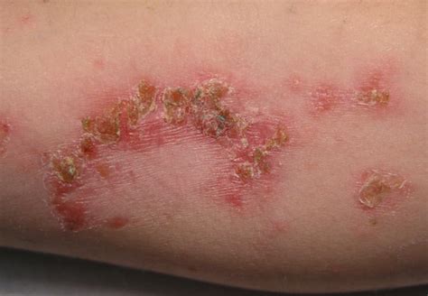 Check spelling or type a new query. Impetigo Contagiosa (Grindflechte) - Symptome, Ursachen ...