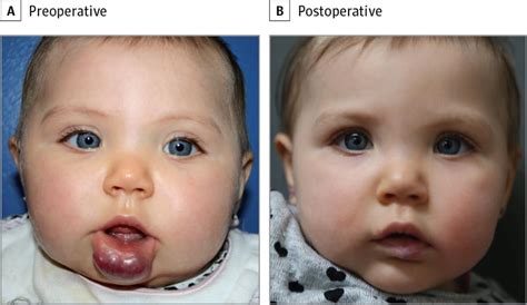 The Tissue Expander Effect In Early Surgical Management Of Select Focal Infantile Hemangiomas