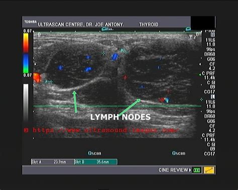 A Gallery Of High Resolution Ultrasound Color Doppler And 3d Images