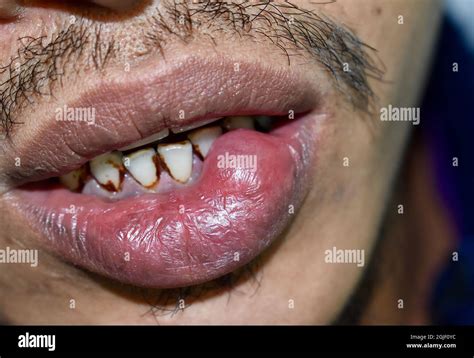 Mouth Abscess Hi Res Stock Photography And Images Alamy