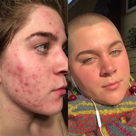 Selfie B A Almost Years Of Cystic Acne Y O And Doing Much Better R Skincareaddiction