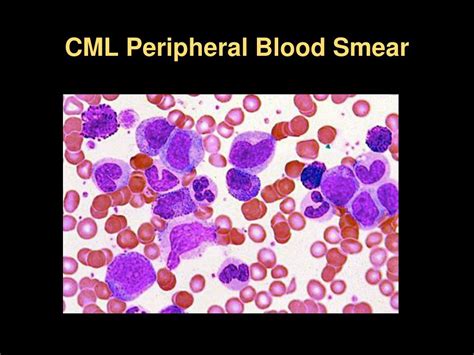 Ppt Chronic M Yeloid Leukemia Powerpoint Presentation Free Download
