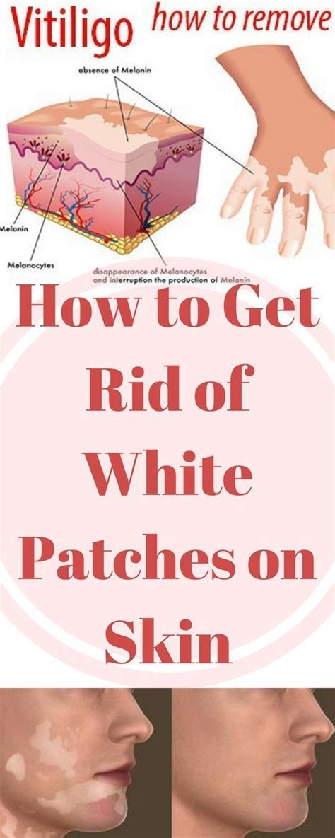 How To Get Rid Of White Patches On Skin Vitiligo Treatment Vitiligo