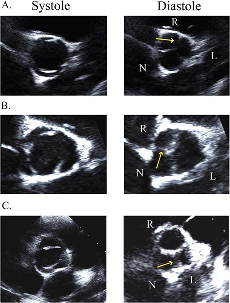Characteristic Morphologies Of The Bicuspid Aortic Valve In Patients With Genetic Syndromes