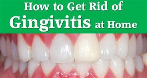After your wisdom teeth have been removed and any swelling and bruising has disappeared, your mouth and face should return to normal. How to Get Rid of Gingivitis Fast at Home | Cure relief ...