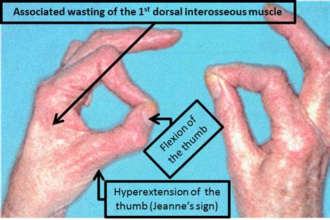 Teach Neurology Froments Sign