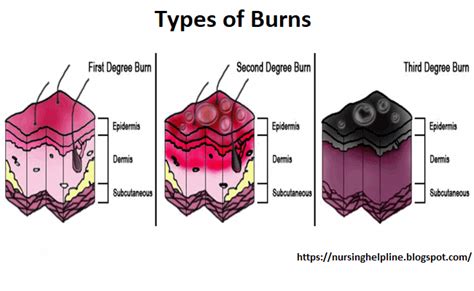 Burn Types Types Of Burns Subcutaneous Tissue Critical Care Nursing
