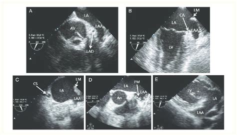 Left Atrial Appendage Evaluation By Transoesophageal Echocardiography