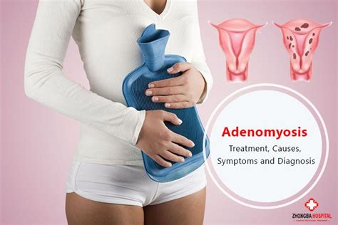 Adenomyosis Symptoms Causes And Treatment Options My XXX Hot Girl