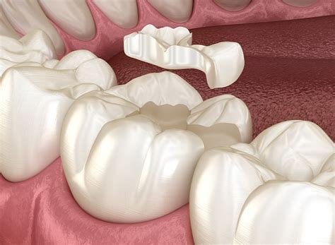 All Ceramic Dental Restorations Mansfield Tx Cosmetic Dentist