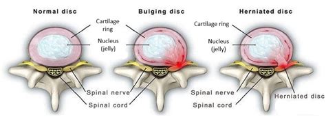 Back Pain Disc Protrusion Vs Herniation Physiovive