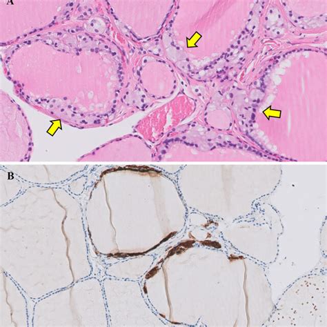 C Cell Hyperplasia In A Patient With Multiple Endocrine Neoplasia Type