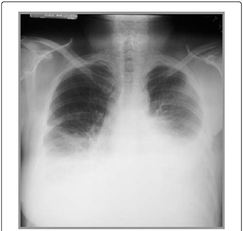 Chest X Ray Showing Bilateral Pleural Effusion And Pulm Open I Sexiezpix Web Porn