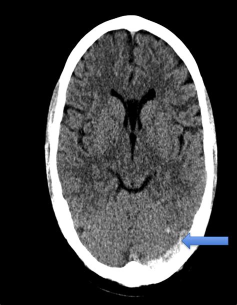 Cerebral Venous Sinus Thrombosis The Forgotten Headache — Nuem Blog