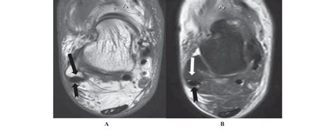 A Axial T1 Weighted And B Stir Axial Mr Images Depicts A Normal
