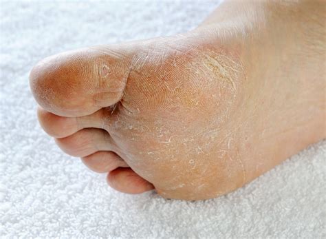 7 Common Skin Problems of the Feet