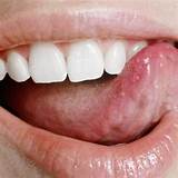Pictures of Sore Gums And Teeth On One Side