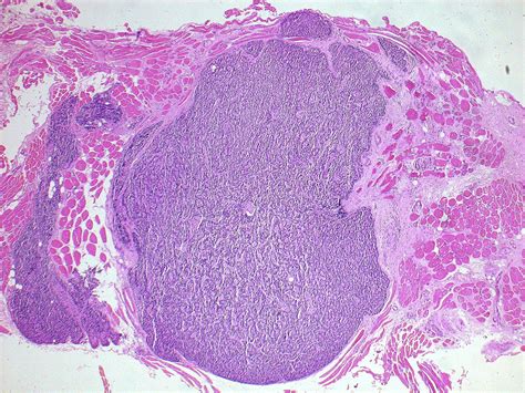 Pathology Of The Parathyroid Glands Diagnostic Histopathology
