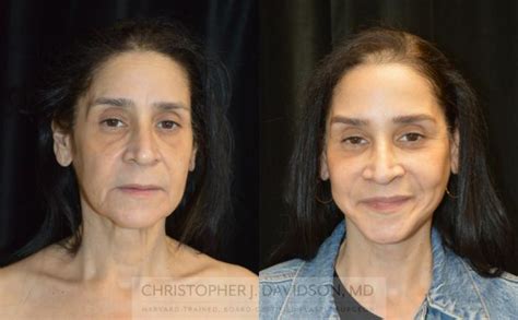 Facelift Surgery Before And After Photo Gallery Boston Ma