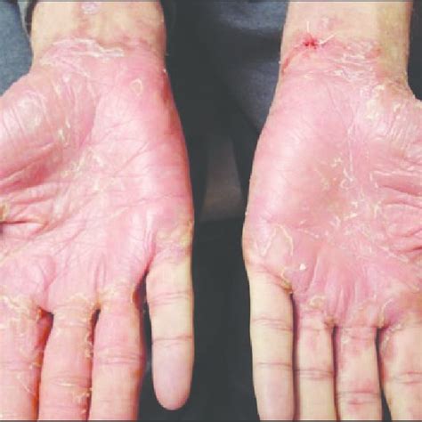 This View Of The Soles Of A 33 Year Old Man With Syphilis Shows