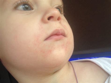 Сыпь у рта у ребенка красные пятна и раздражение вокруг губ причины
